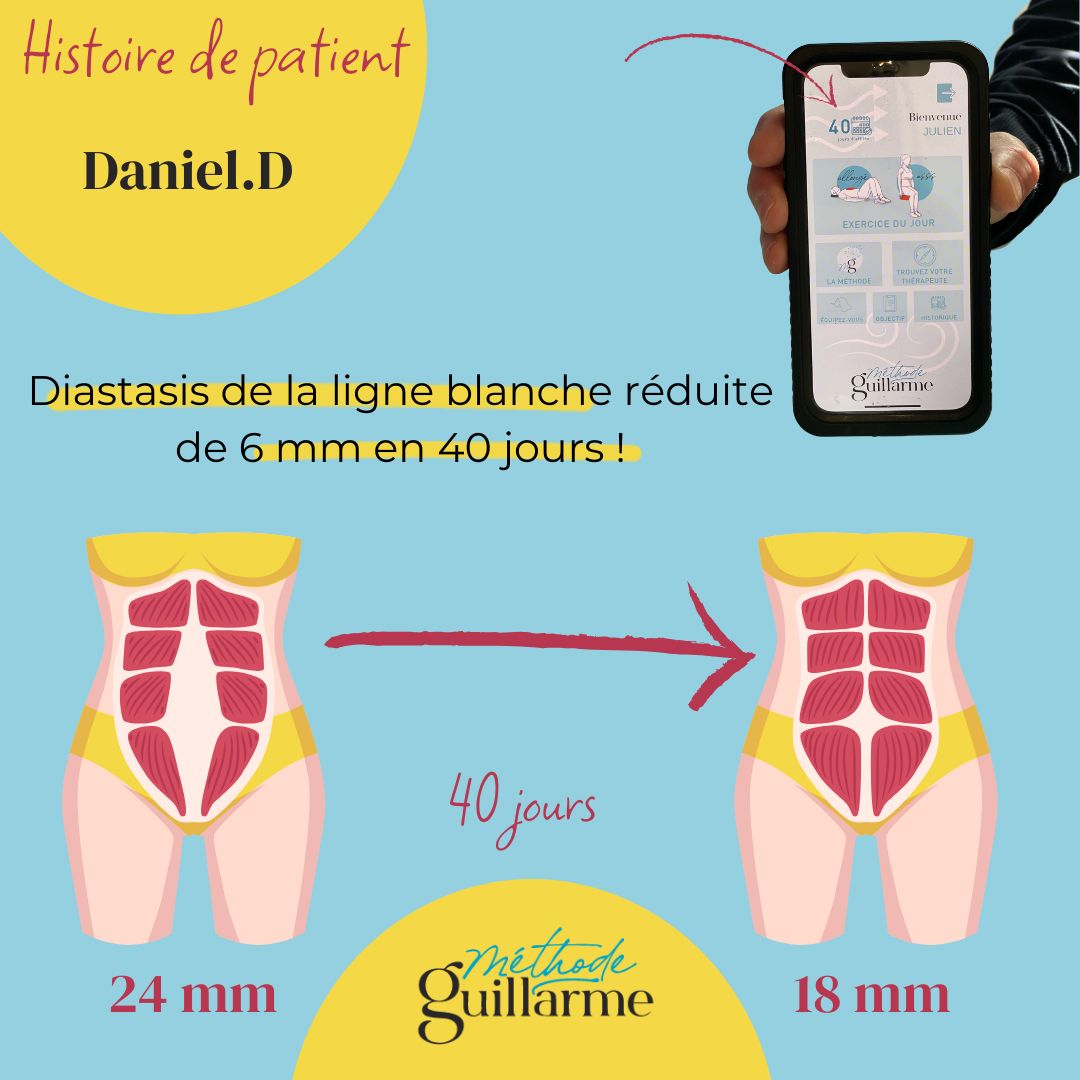 Diastasis réduit – histoire de patient